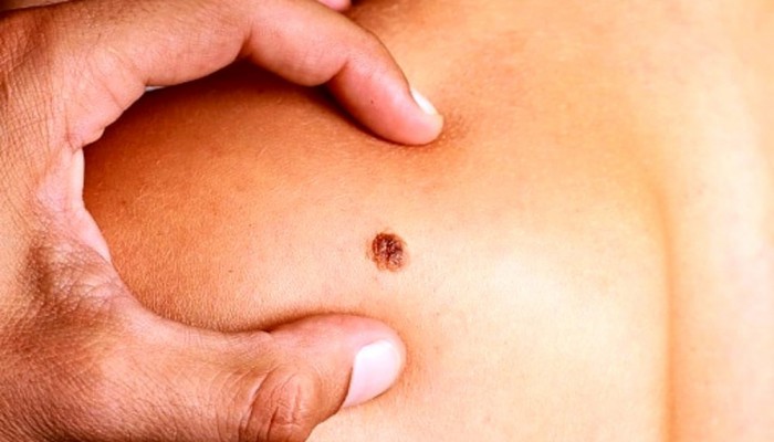 Fă-ți un test HPV rapid, eficient și sigur, la Clinicile SANADOR!